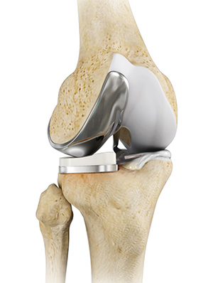 Partial Knee Replacement logo